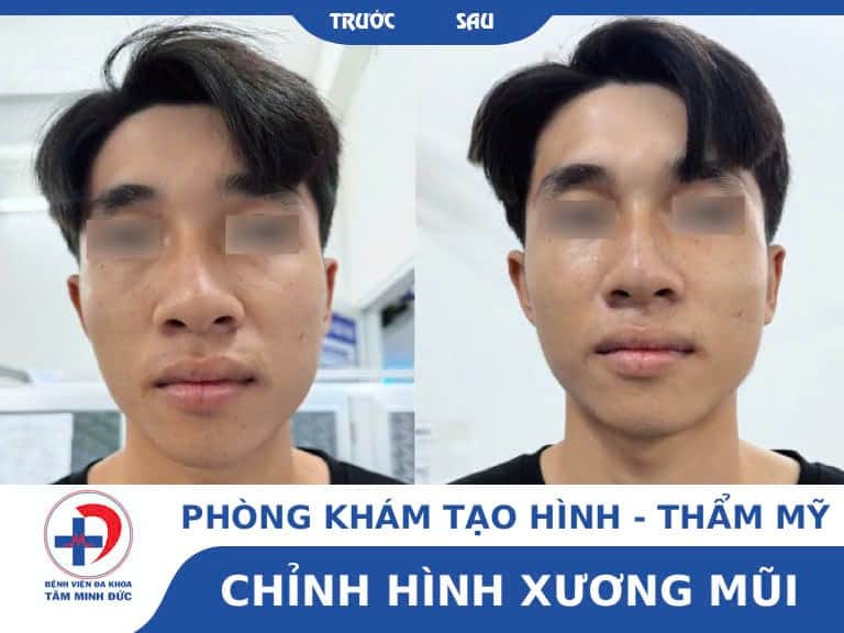 Phẫu thuật chỉnh hình mũi sau tai nạn